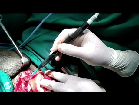 Urethral Reconstruction Using Smart Glasses, Ohana One International 