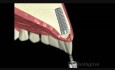 Dental Implant