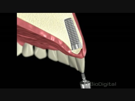 Dental Implant