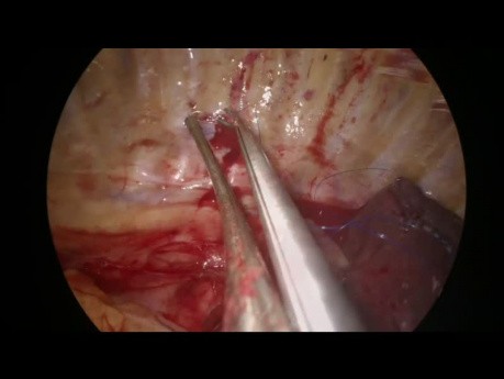Uniportal VATS Sleeve Reimplantation of Middle Lobe to Bronchus Intermedius
