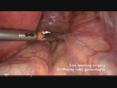 Ambulatory Hysterectomy. Live Teaching Surgery.