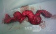 Aneurysm Of Arteriovenous Fistula