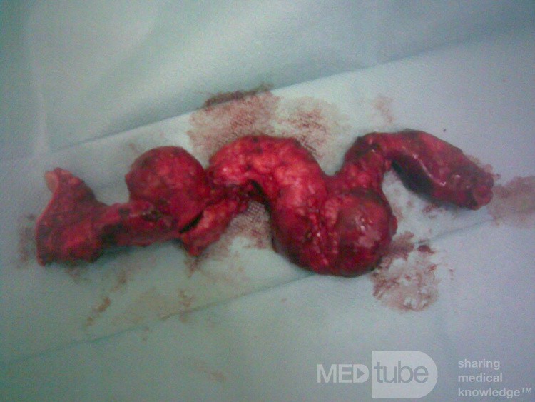 Aneurysm Of Arteriovenous Fistula