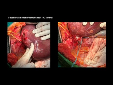 Atypical Liver Resection sg 6-7-8 and Left Colectomy for Synchronous Left Colon Adenocarcinoma and Single Segment 7 Liver Metastasis - Case Presentation