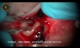 Microsurgery with Different Lasers Wavelength (Gingivectomy, Frenectomy, Apicoectomy)