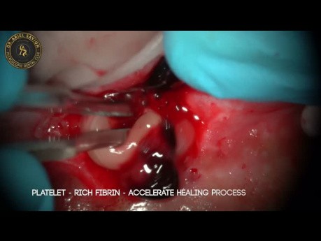 Microsurgery with Different Lasers Wavelength (Gingivectomy, Frenectomy, Apicoectomy)