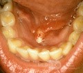 Stone Sublingual Papilla with Obstruction