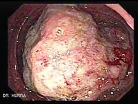 Adenocarcinoma of the Ascending Colon (1 of 2)