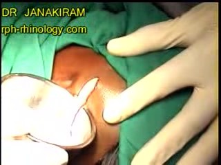 Microtia With Luc's Abscess
