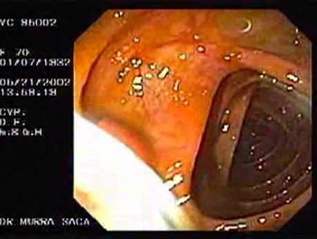 A Tablet of Medicine in the Colon (1 of 2)