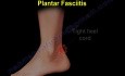 Plantar Fascitis and Heel Pain - Video Lecture 