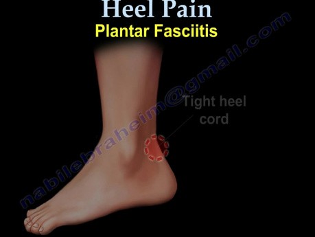 Plantar Fascitis and Heel Pain - Video Lecture 