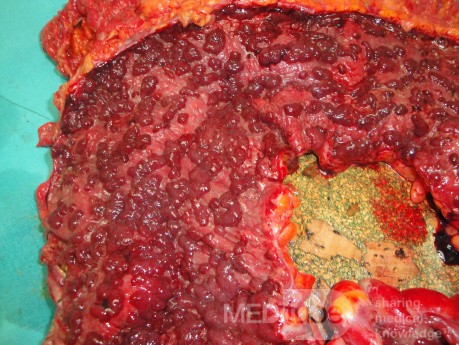 Multiple Rectal Ulcers (86 of 110)