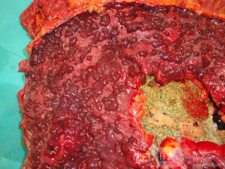 Multiple Rectal Ulcers (86 of 110)