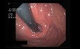 Esophageal Hernia In Endoscopy