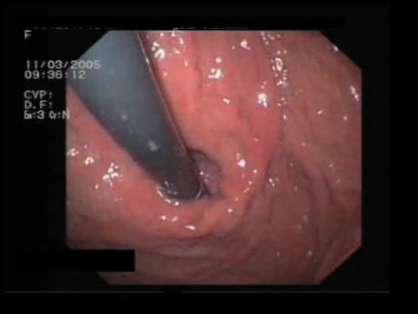 Esophageal Hernia In Endoscopy