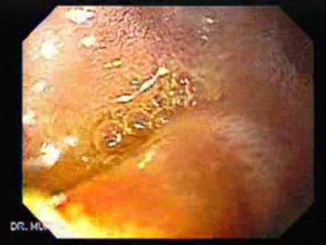 Duodenal Diverticula