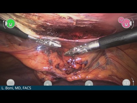 Umbilical Hernia Repair with Versius - Luigi Boni