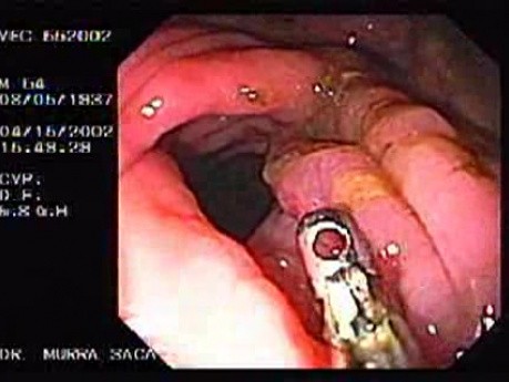Zollinger- Ellison Syndrome - Gastric Ulcer with Gastrocolic Fistula (8 of 21)