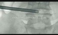 Full-Endoscopic Extreme Lateral Transforaminal Approach for L4-L5 Discectomy