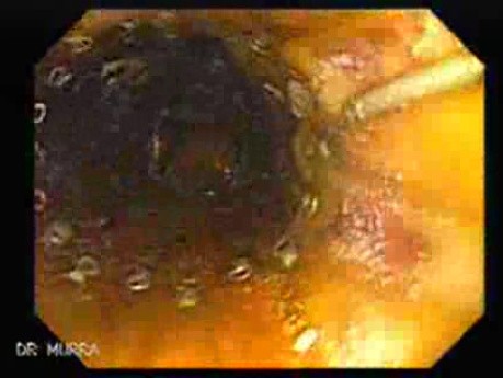 Adenocarcinoma of the Cardia and Carcinoma Epidermoid of the Larynx (12 of 26)