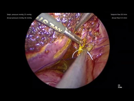 Aberrant Right Hepatic Duct Entering A Short Cystic Duct Diagnosed At Laparoscopic Cholecystectomy
