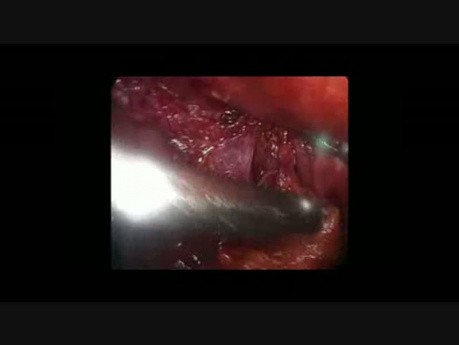 Critical View of Safety in Fundus-First Difficult Lap Cholecystectomy