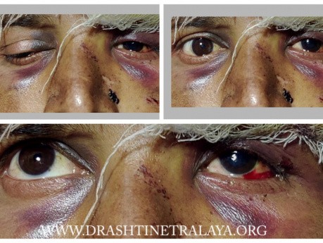 Orbital Floor Roof and Zygomatic Arch Fracture - Successful Management
