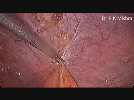 Laparoscopic Repair of Incisional Hernia