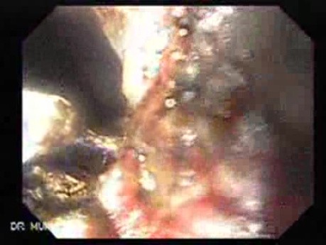 Long Standing Alcohol Abuse - Argon Plasm Coagulation, Part 3