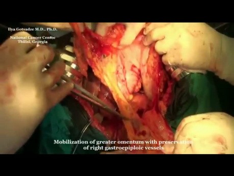 Proximal subtotal gastrectomy for stomach adenocarcinoma
