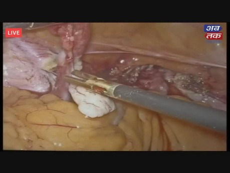 Live 3D - TLH, Uterine Fibroid Treatment