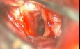 Brain Aneurysm - Anterior Choroidal Aneurysm - Microsurgical Clipping
