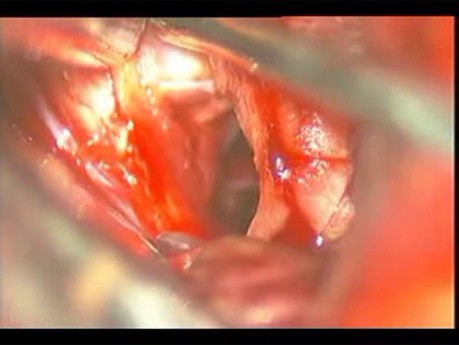 Brain Aneurysm - Anterior Choroidal Aneurysm - Microsurgical Clipping
