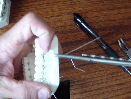 Wiring Fractured Jaw - Erich Arch Bars