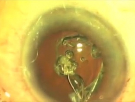 Quick Fugo Plasma Blade Capsulotomy. Closer to the Nanotechnology
