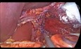 Guidelines for Intraoperative Assessment of Type I Sliding Hiatal Hernias