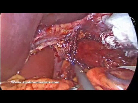 Guidelines for Intraoperative Assessment of Type I Sliding Hiatal Hernias