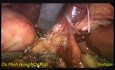 Laparoscopic Choledochal Cysts Excision