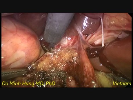 Laparoscopic Choledochal Cysts Excision