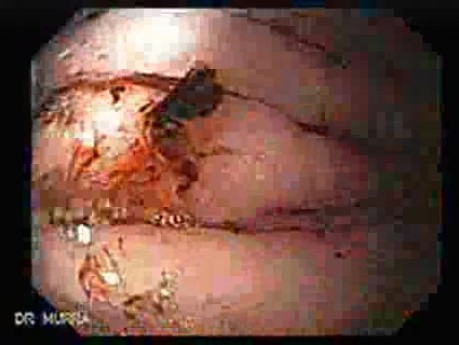 Dieulafoy´s Lesion (Exulceratio Simplex) (3 of 9)