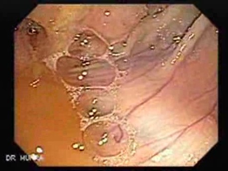 Adenocarcinoma Of The Cecum (1 of 3)