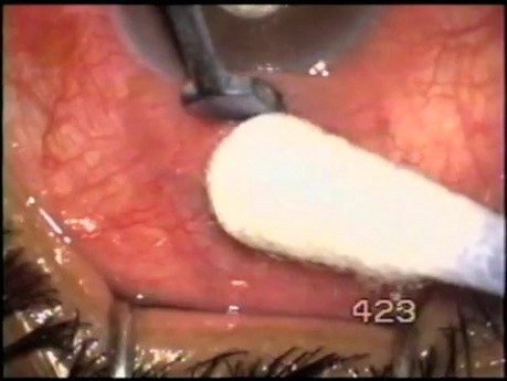 Phakomorphic glaucoma - transciliary filtration
