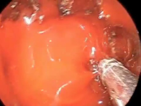 Endoscopic Skull Base Surgery - Endonasal Control of Bleeding