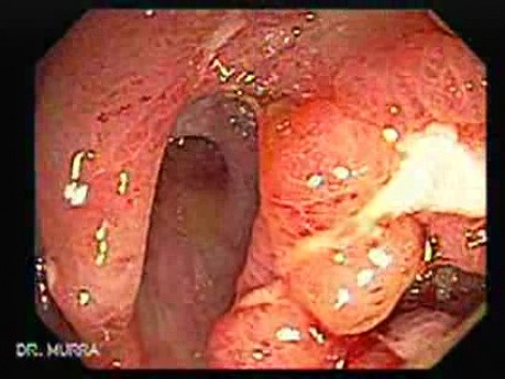 Severe case of Ischemic Colitis (3 of 19)
