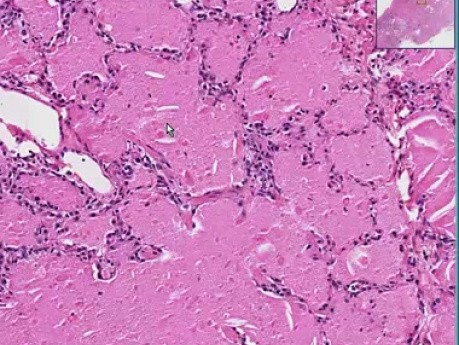 Alveolar proteinosis