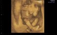 Ultrasound Image of Pregnancy