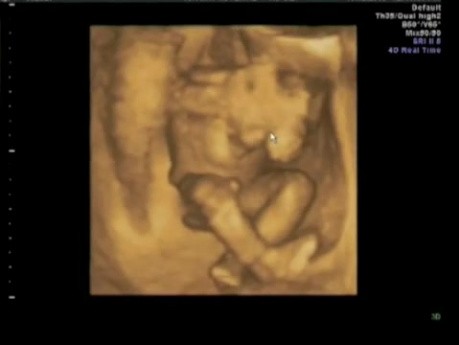 Ultrasound Image of Pregnancy