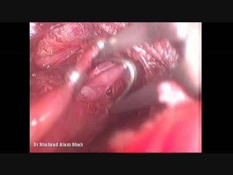 Endoscopic Thyroidectomy: How I do It.