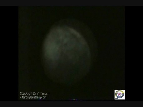 Embryoscopy